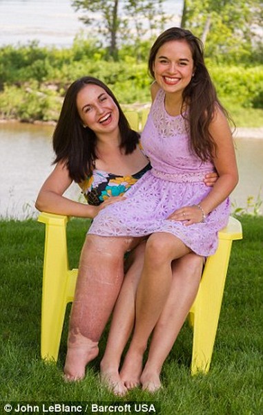 Teen With Shockingly Swollen Leg Poses in a Bikini to Inspire Body Confidence